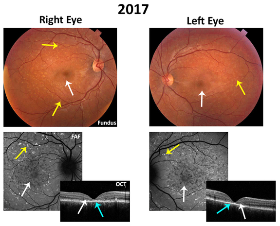 Fundus Flavimaculatus Oct Diagnosis And Management Of Stargardt 